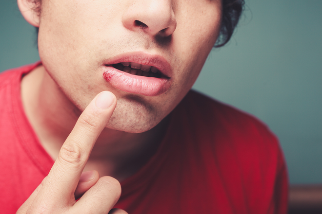 Prevent &amp; Heal Cold Sores