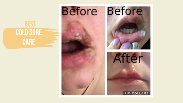 Prevent & Heal | Lemon Balm & Geranium | Cold Sore Treatment Lip Balm